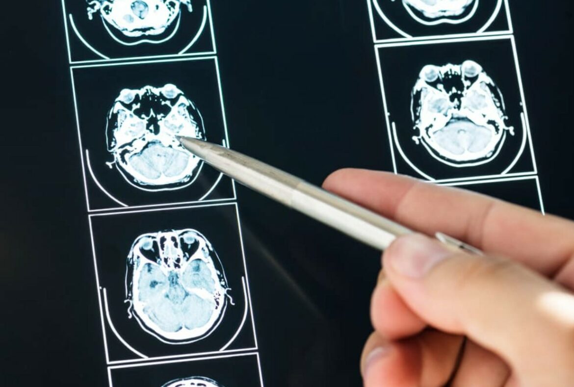 ¿Cuál es el factor clave para prevenir diferentes tipos de ACV?, según un nuevo estudio